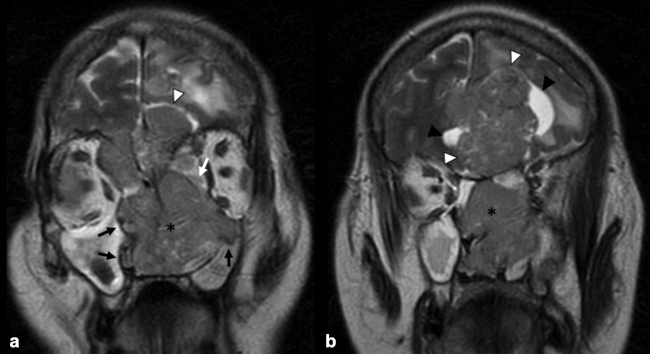 Estesioneuroblastoma tipo C según la clasificación de Kadish. (a) y (b) RM craneoencefálica secuencia potenciada en T2 en plano coronal. Voluminosa lesión ocupante de espacio que presenta una intensidad de señal heterogénea y se localiza a nivel de cavidad nasal (asterisco negro), con destrucción ósea, que invade órbitas (flecha blanca), así como senos paranasales (flecha negra), nasofaringe y fosa cerebral anterior (punta de flecha blanca), donde se visualiza componente quístico periférico (punta de flecha negra).