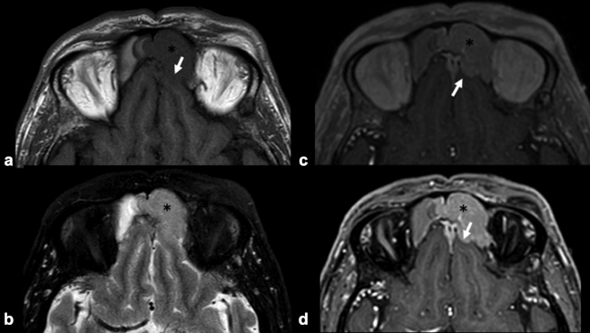 RM craneoencefálica en plano axial. (a) Secuencia potenciada en T1. Lesión levemente hipointensa respecto a la sustancia gris que ocupa el seno frontal izquierdo (asterisco negro) y que destruye la pared posterior del mismo extendiéndose a fosa craneal anterior (flecha blanca). (b) Secuencia potenciada en T2 con supresión grasa. La lesión se muestra hiperintensa respecto a la sustancia gris en esta secuencia. (c) Secuencia potenciada en T1 con contraste paramagnético (Gadolinio) y (d) secuencia potenciada en T1 con supresión de la grasa y contraste paramagnético (Gadolinio). En esas secuencias, la lesión muestra un realce homogéneo y pone de manifiesto una infiltración subdural sin extensión encefálica. 