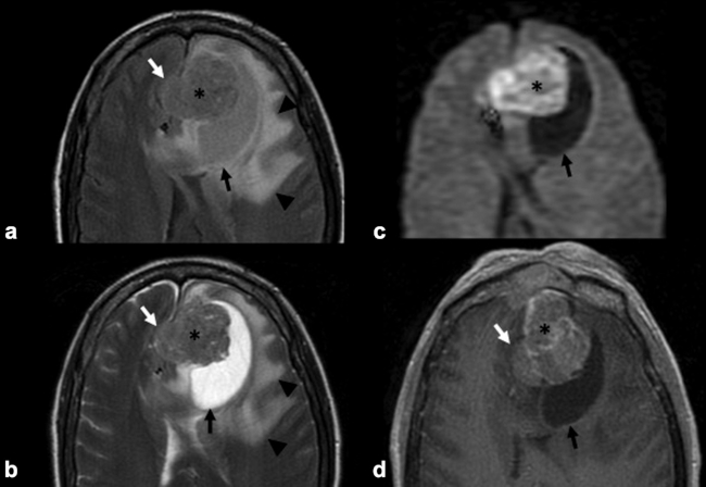 RM craneoencefálica en plano axial. (a) Secuencia FLAIR. (b) Secuencia potenciada en T2. (c) Secuencia de difusión y (d) secuencia potenciada en T1 con contraste paramagnético (Gadolinio). Afectación de la fosa cerebral anterior por masa procedente de fosa nasal (asterisco negro), que a nivel de encefálico ocasiona importante efecto de masa, con presencia de cavidad quística periférica (flecha negra) e importante edema perilesional de morfología digitiforme (punta de flecha negra), que ocasiona herniación subfalcial (flecha blanca). La citada masa tiene una intensidad de señal heterogénea, hiperintensa respecto a la sustancia gris en secuencias potenciadas en T2 y presenta una moderada restricción de la difusión hídrica y un realce leve tras la administración de contraste paramagnético.