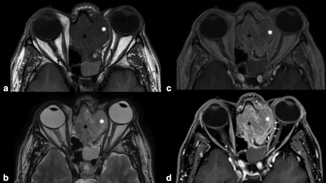 RM craneoencefálica en plano axial- (a) Secuencia potenciada en T1. (b) Secuencia potenciada en T2. (c) Secuencia potenciada en T1 con contraste paramagnético (Gadolinio) y (d) secuencia potenciada en T1 con supresión de la grasa y contraste paramagnético (Gadolinio). Lesión ocupante de espacio, hipointensa respecto a la sustancia gris en secuencias potenciadas en T1 y moderadamente hiperintensa en secuencias potenciadas en T2 con captación heterogénea de contraste, que ocupa fosa nasal izquierda (asterisco negro) y celdillas etmoidales y destruye la lámina orbitaria izquierda, con extensión intraorbitaria extraconal (asterisco blanco) y compresión del músculo recto interno izquierdo sin aparente infiltración del mismo. Eso se valora mejor en las secuencias con saturación grasa (d), donde se objetiva una línea de separación hipointensa entre la lesión y músculo (interfaz tumor-grasa) (flechas blancas), que sugiere que la lesión está contenida en la fascia periorbital. 