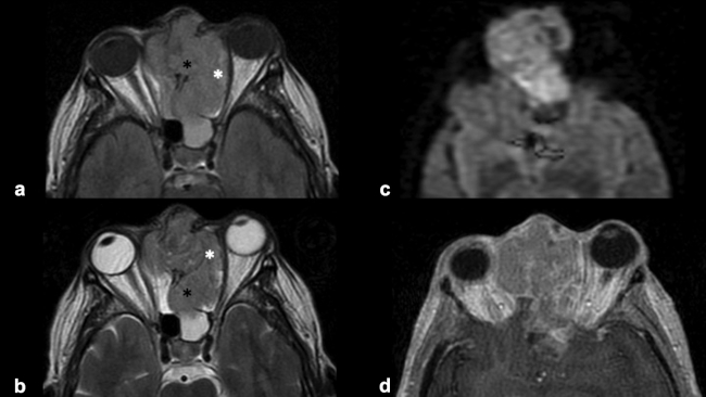 RM craneoencefálica en plano axial. (a) Secuencia FLAIR. (b) Secuencia potenciada en T2. (c) Secuencia de difusión y (d) secuencia potenciada en T1 con contraste paramagnético (Gadolinio). Lesión ocupante de espacio localizada en fosa nasal y celdillas etmoidales que presenta destrucción ósea (asterisco negro) e invasión orbitaria extraconal (asterisco blanco). La masa es discretamente hiperintensa respecto a la sustancia gris en secuencias potenciadas en T2 y presenta una moderada restricción de la difusión hídrica y un discreto realce tras la administración de contraste paramagnético.