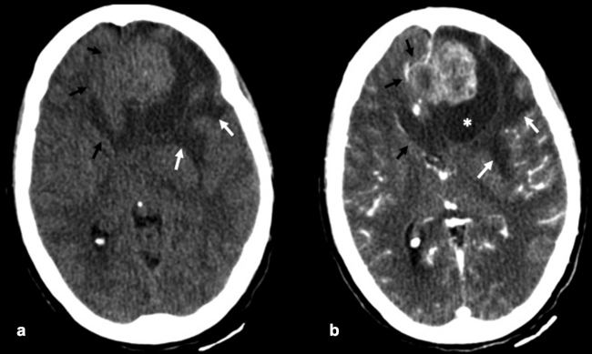 TC craneoencefálica plano axial (a) sin contraste intravenoso y (b) con contraste intravenoso yodado. Extensión intracraneal parenquimatosa con afectación frontal izquierda extensa ocupando línea media. Se visualiza un efecto de masa parenquimatoso cerebral con edema circundante (flechas blancas) y herniación subfalcial asociada con desviación de línea media a la derecha (flechas negras). Tras la administración de contraste intravenoso, se aprecia un componente quístico en región frontal izquierda (asterisco blanco).