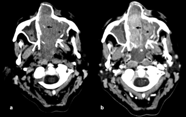 TC craneoencefálica plano axial (a) sin contraste intravenoso y (b) con contraste intravenoso yodado. Masa homogénea de tejido blando con pequeñas calcificaciones puntiformes en su interior (flechas negras), que ocupa fosas nasales con destrucción ósea y extensión a ambos senos maxilares (asteriscos negros), así como extensión caudal posterior a nasofaringe (asterisco blanco).