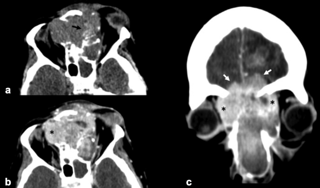 TC craneoencefálica plano axial (a) sin contraste intravenoso y (b) con contraste intravenoso yodado. (c) Reconstrucción Multiplanar (MPR) coronal de TC craneoencefálica con contraste intravenoso yodado. Lesión de fosas nasales con calcificaciones punteadas en su interior (flechas negras), que capta contraste y que produce destrucción ósea con invasión de ambas órbitas (asteriscos negros) y seno frontal con extensión intracraneal frontal (flechas blancas).
