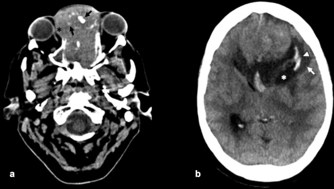 TC craneoencefálica plano axial sin contraste intravenoso. (a) Voluminosa masa de partes blandas con calcificaciones puntiformes en su interior (flechas negras) que ocupa fosas nasales y produce destrucción ósea extendiéndose a orbita derecha y seno frontal (asterisco negro). (b) La masa también se extiende a fosa cerebral anterior, donde presenta contenido quístico en su polo posterior (asterisco blanco) y edema perilesional (flecha blanca). Ejerce un importante efecto de masa con compresión del asta frontal de ventrículo lateral izquierdo y desplazamiento de la línea media hacia la derecha. Además, se observan varios focos de sangrado parenquimatoso asociados (punta de flecha blanca).
