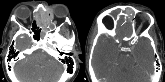 (a) TC craneoencefálica con contraste intravenoso yodado en plano axial. Muestra masa de partes blandas con pequeñas calcificaciones puntiformes en su interior (flecha blanca), que da lugar a una destrucción ósea con extensión intraorbitaria izquierda extraconal que comprime el músculo recto interno izquierdo (asterisco negro), así como extensión a celdillas etmoidales anteriores bilaterales. (b) TC craneoencefálica con contraste intravenoso yodado en plano axial. Extensión de la lesión de partes blandas a seno frontal izquierdo (asterisco blanco) con destrucción ósea (flecha negra) y extensión intracraneal en fosa anterior.