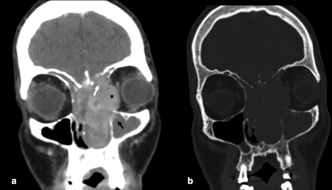 (a) MPR plano coronal de TC craneoencefálica con contraste intravenoso yodado. Gran masa de partes blandas que ocupa la fosa nasal izquierda con destrucción ósea y extensión intraorbitaria izquierda (asterisco negro), extensión a seno maxilar izquierdo (flecha negra), destrucción del suelo del seno frontal izquierdo y destrucción de la lámina cribiforme izquierda y extensión intracraneal (flecha blanca). (b) MPR plano coronal de TC craneoencefálica con ventana de hueso. Se objetiva destrucción de lámina papirácea, celdillas etmoidales, hueso lacrimal izquierdo, lámina orbitaria izquierda, la lámina cribiforme izquierda y apófisis crita galli.