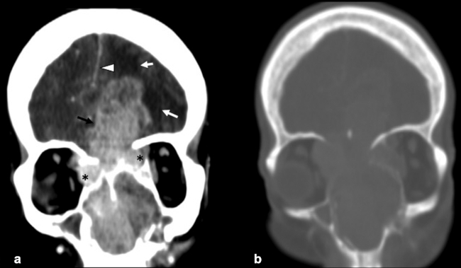 MPR coronal de TC craneoencefálica con contraste intravenoso yodado (a) ventana de partes blandas y (b) ventana de hueso. Voluminosa tumoración que ocupa fosas nasales con extensión a ambas órbitas, predominantemente órbita derecha (asterisco negro) y seno frontal. Destrucción ósea de lámina papirácea, lámina orbitaria y la lámina cribosa. Extensión intracraneal parenquimatosa con afectación frontal izquierda extensa (flecha negra) y edema asociado (flecha blanca), que ejerce efecto de masa con herniación subfalcial y desviación de línea media a la derecha (punta de flecha blanca).