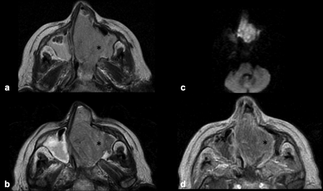 RM craneoencefálica en plano axial. (a) Secuencia FLAIR. (b) Secuencia potenciada en T2. (c) Secuencia de difusión y (d) secuencia potenciada en T1 con contraste paramagnético (Gadolinio). Lesión ocupante de espacio localizada en fosa nasal que da lugar a destrucción ósea e invasión de seno maxilar izquierdo (asterisco negro). La masa presenta una moderada restricción de la difusión hídrica y realza tras la administración de contraste paramagnético.