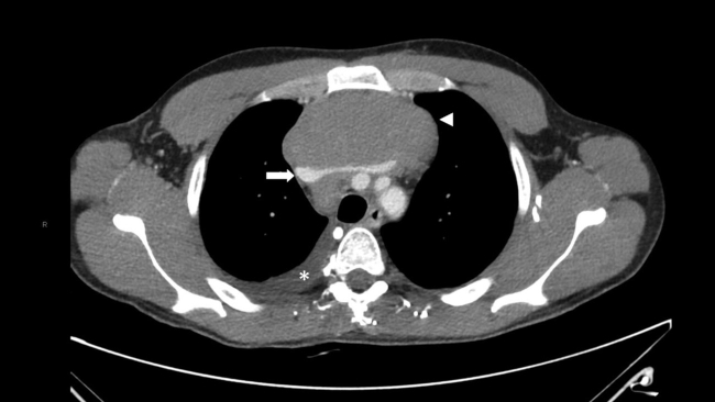 Imagen de TC en plano axial y adquisición en fase portal. Voluminosa masa de densidad similar al músculo, homogénea, bien delimitada, en mediastino anterior de unos 100 50mm de diámetro máximo (cabeza de flecha) que engloba estructuras vasculares y las desplaza (flecha), compatible con conglomerado adenopático. Derrame pleural derecho (asterisco).