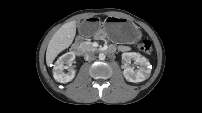 Imagen de TC en plano axial y adquisición en fase portal. Riñones de tamaño y morfología normales con múltiples lesiones focales, hipodensas, bilaterales y de aspecto sólido (cabeza de flecha), compatible en el contexto del paciente con infiltración linfomatosa.