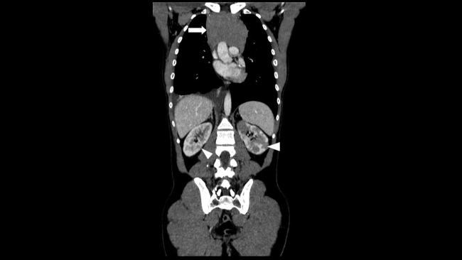 TC con reconstrucción multiplanar (MPR) coronal oblicua y adquisición en fase portal. Se identifica la masa mediastínica descrita en ►Figura 1(flecha) y las múltiples lesiones focales hipodensas, en región cortical de ambos riñones (cabeza de flecha).