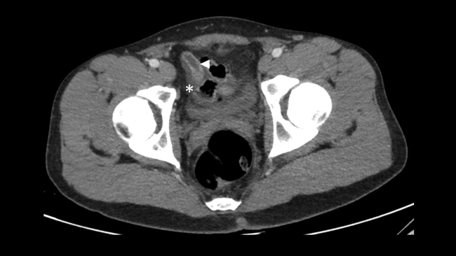 Imagen de TC en plano axial y adquisición en fase portal. Detalle del extremo distal del apéndice con cambios inflamatorios, con aumento del calibre y realce parietal, con diámetro transverso máximo de 8 mm (cabeza de flecha) y con líquido libre periapendicular (asterisco), secundario a la obstrucción por afectación linfomatosa proximal.