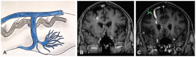 (A) Dibujo esquemático que demuestra a las venas de disposición radial a lo largo de la pared del ventrículo lateral con drenaje en una vena cortical dilatada. (B) Corte coronal de secuencia ponderada en T1 con contraste. Confluencia de las venas medulares dispuestas radialmente alrededor de una vena colectora central. (C) Mismo paciente evidenciándose vena de drenaje cortical dilatada (flecha verde).