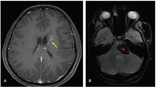 (A) Secuencia ponderada T1 con contraste con una AVD izquierda que drena a una vena ependimaria (flecha amarilla). (B) Cavernoma de tronco en el mismo paciente visualizado en secuencia EPI GRE (estrella).