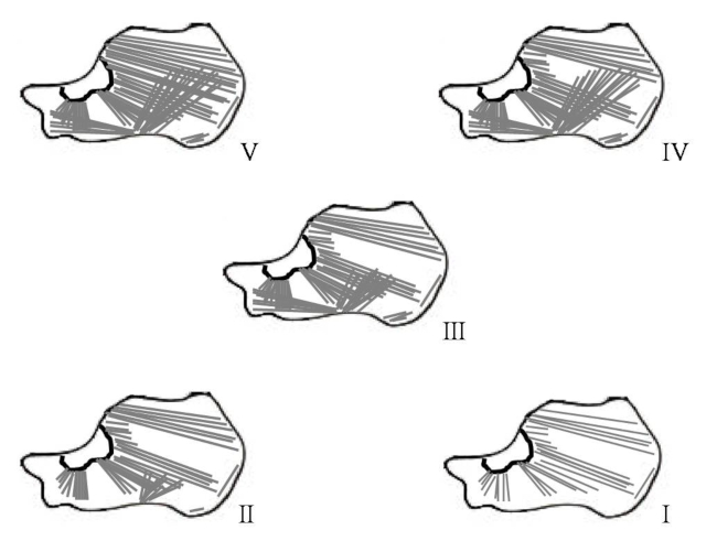 Fases en las modificaciones de la estructura trabecular calc&aacute;nea propuestas por Jhamaria y col. Fase I: osteoporosis severa. Fase II: osteoporosis. Fase III: borderline. Fases IV y V: normal.