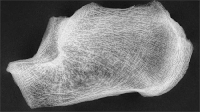 Fase V del &iacute;ndice trabecular calc&aacute;neo.