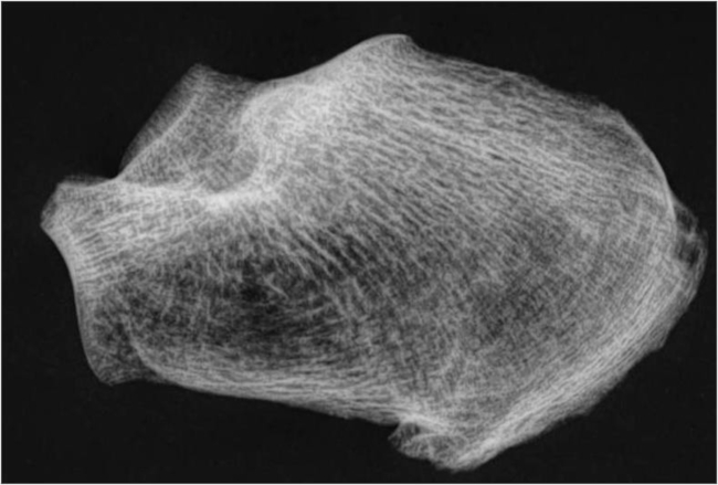 Fase III del &iacute;ndice trabecular calc&aacute;neo.