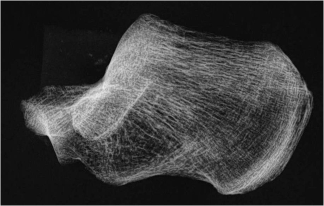 Fase I del &iacute;ndice trabecular calc&aacute;neo.