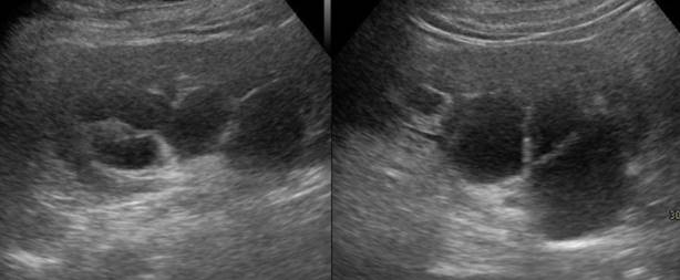 Ecograf&iacute;a renal. Ri&ntilde;ones aumentados de tama&ntilde;o, presentando a nivel de ambos senos renales m&uacute;ltiples quistes multiloculados, de paredes finas y contenido anecoico homog&eacute;neo.