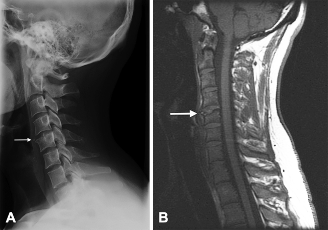 (A) La radiografía lateral de la columna cervical muestra un pequeño fragmento óseo, con márgenes bien definidos, sobre el ángulo anterosuperior del quinto cuerpo vertebral cervical (flecha). (B) RM cervical sagital potenciada en T1 que muestra una separación de un fragmento de hueso triangular (flecha) en el ángulo anterosuperior del quinto cuerpo vertebral cervical.
