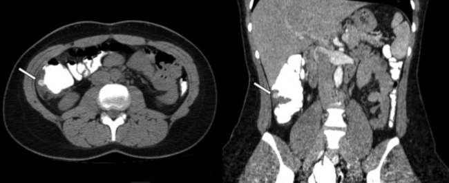 Estadio IA. Paciente de 31 años se presenta al servicio de emergencias con cuadro de dolor abdominal agudo en flanco derecho y sospecha clínica de apendicitis. A nivel del colon ascendente, se visualiza imagen diverticular (flecha) asociada a engrosamiento parietal colónico, rarefacción de la grasa, imágenes ganglionares fuera de rango adenomegálico adyacentes y escasa cantidad de líquido libre laminar en gotiera parietocólica.