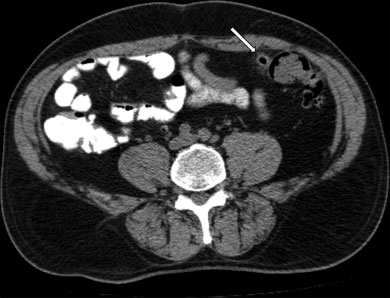 Estadio 0. A nivel del colon sigmoide, en concordancia con región dolorosa referida por el paciente, se identifica imagen diverticular asociada a engrosamiento parietal (flecha), sin evidencia de cambios inflamatorios significativos loco-regionales.