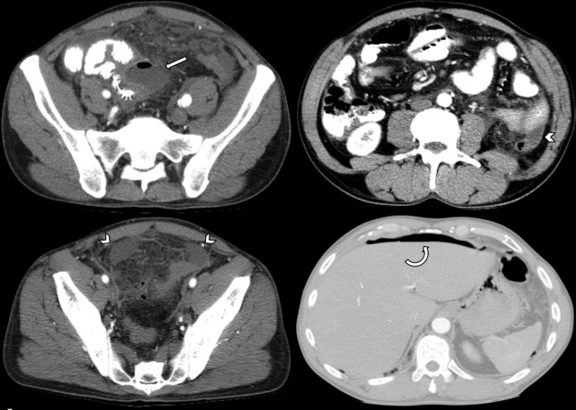 Estadio IV. A nivel del colon transverso se identifica imagen diverticular con signos inflamatorios, asociada a colección pericólica (flecha recta) con nivel hidroaéreo, de 45 27 mm en plano axial. Se identifica además rarefacción difusa de la grasa intraperitoneal, líquido libre perihepático, periesplénico, y en ambas gotieras parietocólicas con engrosamiento del peritoneo parietal (cabezas de flecha). Además, se observan signos de neumoperitoneo (flecha curva).