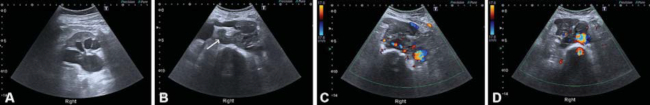 Imágenes del estudio ecográfico en modo B (A y B) y con Doppler color (C y D), en las que se observa el adelgazamiento de la cortical renal derecha con dilatación del sistema pielocalicial y uréter proximal hasta una masa retroperitoneal (flecha blanca en B), con vascularización detectable a la derecha de la aorta.