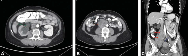Cortes axiales (A y B) y coronal (C) más representativos del estudio TC, donde se visualiza la dilatación de la vía urinaria derecha (flecha verde) secundaria a una gran masa retroperitoneal (flechas rojas), polilobulada y heterogénea, que engloba al uréter y la vena cava inferior extendiéndose más allá de la bifurcación iliaca y contacta con la cúpula uterina (flecha azul).