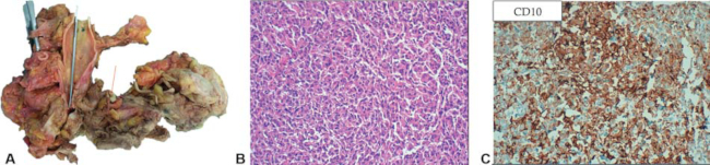 Aspecto macroscópico y microscópico del tumor. En la pieza macroscópica (A) se observa el crecimiento de la lesión desde las venas uterinas derechas (flecha roja en A). En B se observa aspecto microscópico de la lesión tras la tinción de hematoxilina-eosina y en C se evidencia positividad del marcador inmunohistoquímico CD10 en la muestra, específico para los tumores del estroma endometrial.