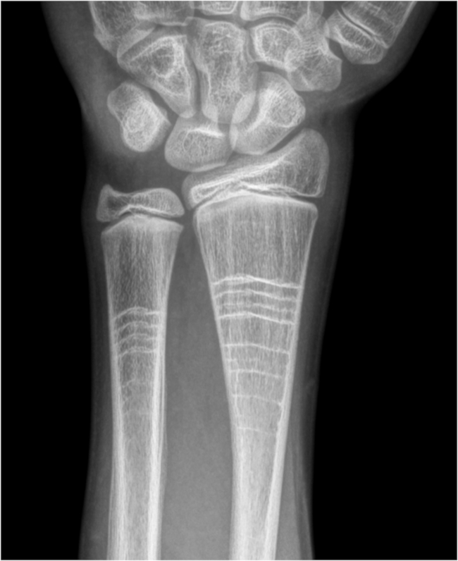 Radiografía de muñeca de un paciente masculino de 14 años. Había recibido tratamiento con bifosfonatos por antecedente de ostegénesis imperfecta. Nótense las bandas radiodensas paralelas al cartílago de crecimiento desplazadas hacia la diáfisis, constituyendo el signo de las líneas de cebra.