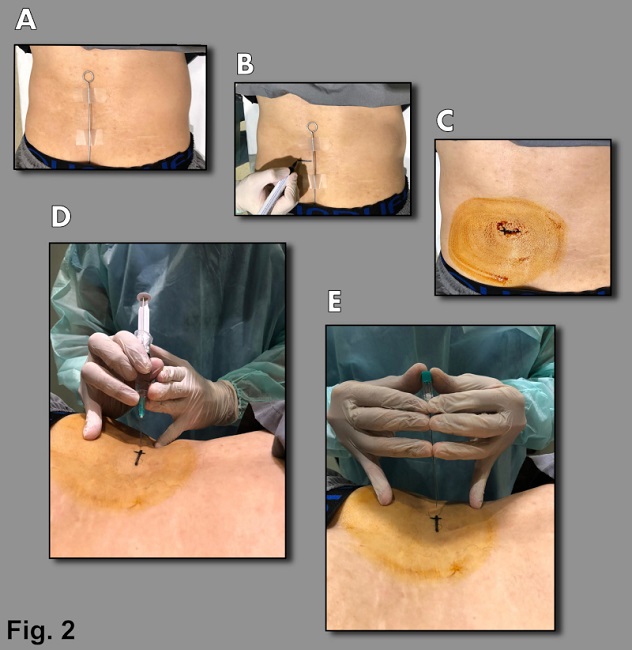 Técnica de punción. (A) Se ubica al paciente en decúbito prono y se coloca un marcador metálico a nivel dorsal en la piel. (B) Mediante TC se identifica la raíz nerviosa afectada y se marca con tinta indeleble la zona cutánea de punción. (C) Se realiza antisepsia con iodopovidona. (D) Se aplica anestesia local con lidocaína al 2%. (E) Se introduce una aguja espinal 21 G hasta el lugar afectado donde, luego de verificar mediante TC, se inyecta una solución compuesta de 30 mg de triamcinolona y 1,5 mg de clorhidrato de bupivacaina.