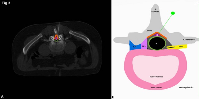 (A) TC sin contraste, corte axial. Bloqueo epidural a nivel de L5S1 izquierdo. Paciente en decúbito prono. Luego de la aplicación de aire y de asegurarnos de la ubicación adecuada en el espacio epidural, se procedió al pasaje de la medicación. (B) Esquema en el que se detalla la anatomía regional. EE: espacio epidural; ST: saco tecal; borde verde: dura madre; CC: canal central; RL: receso lateral; FN: foramen neural; líneas naranjas: ligamento amarillo.