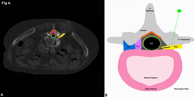 (A) TC sin contraste, corte axial. Bloqueo selectivo foraminal izquierdo a nivel de L5 izquierda, paciente en decúbito prono. Se observa la aguja con su extremo en contacto con la raíz. (B) Esquema donde se detalla la anatomía regional. S.T: saco tecal; borde verde: dura madre; CC: canal central; RL: receso lateral; FN: foramen neural; líneas naranjas: ligamento amarillo.