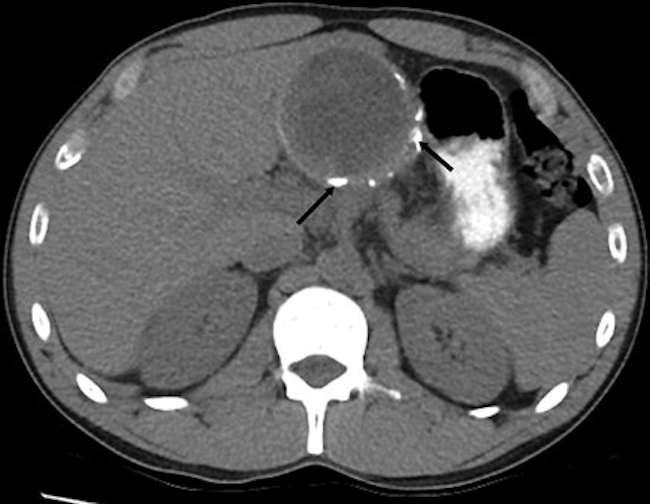 Tomografía computada de abdomen sin contraste intravenoso, corte axial: se observa en el segmento hepático II una lesión focal redondeada hipodensa, de contornos parcialmente calcificados (flechas). Gharbi tipo IV-CE4.
