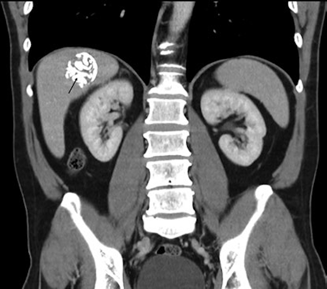Tomografía computada de abdomen con contraste intravenoso, corte coronal: se evidencia en el lóbulo hepático derecho una imagen redondeada, completamente calcificada (flecha). Estudio microscópico: cápsula esclerohialina, calcificada, y otra multilaminar asociada a material gredoso amorfo.