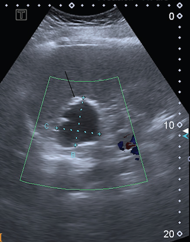 Mujer de 58 años, oriunda de Entre Ríos, asintomática. Ecografía de abdomen: lesión focal anecoica de bordes ecogénicos compatibles con calcificaciones (flecha), localizada en el parénquima hepático. Gharbi tipo V-CE5.