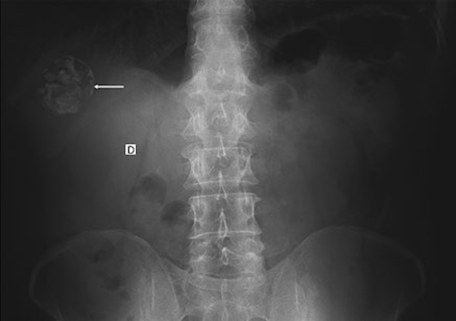 Radiografía de abdomen, de pie, de la paciente de la figura 11: se visualiza una imagen ovalada radioopaca en el hipocondrio derecho (flecha). Gharbi V-CE5.