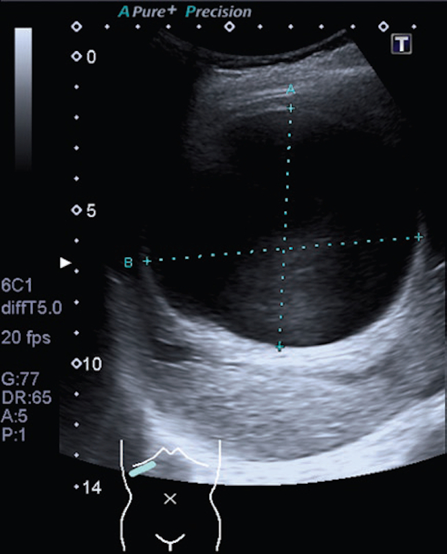 Mujer de 55 años que presenta dolor abdominal difuso. Ecografía abdominal: voluminosa imagen quística con márgenes hiperecogénicos en el lóbulo hepático derecho y refuerzo acústico posterior. Gharbi I-CE1.