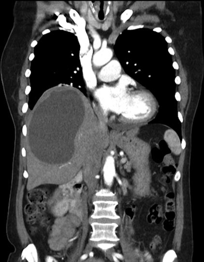 Tomografía computada de abdomen de la paciente de la figura 3, corte coronal con contraste. Imagen quística de aspecto simple en el parénquima hepático. Estudio microscópico: tejido hepático con cápsula consistente de quiste hidatídico. Gharbi I-CE1.