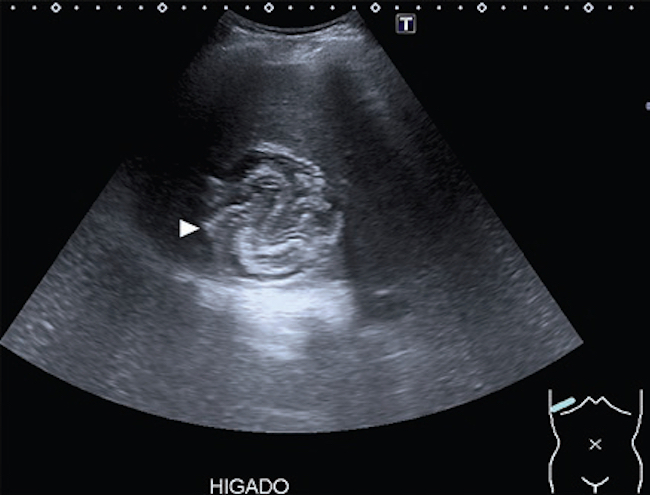Paciente de 48 años que presenta dolor en el hipocondrio derecho. Ecografía de abdomen: se observa en el parénquima hepático una lesión heterogénea con imágenes lineales ecogénicas en su interior (punta de flecha) y refuerzo acústico posterior. Gharbi tipo II-CE3.