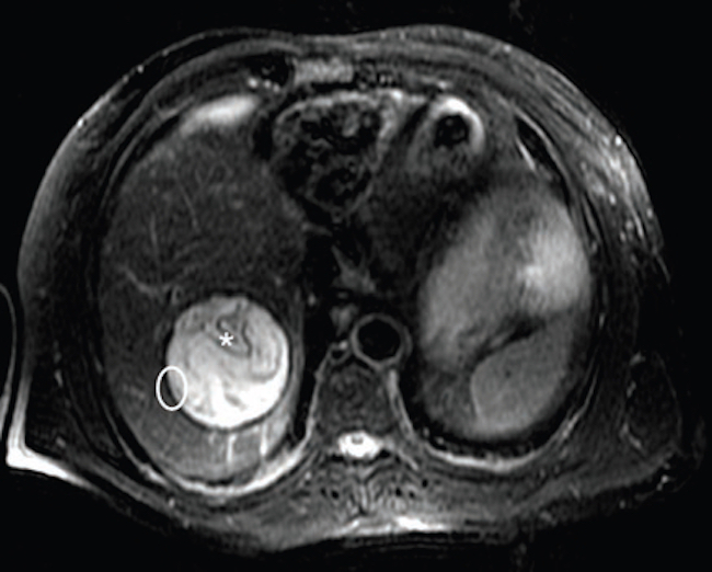 Resonancia magnética de abdomen T2-FS, corte axial: lesión focal en el segmento hepático VII con comportamiento de señal heterogéneo, predominantemente hiperintenso, con imágenes lineales hipointensas de aspecto en «membranas desplegadas» (asterisco), asociado a halo hipointenso correspondiendo al signo del anillo (elipse blanca). Gharbi tipo II-CE3.