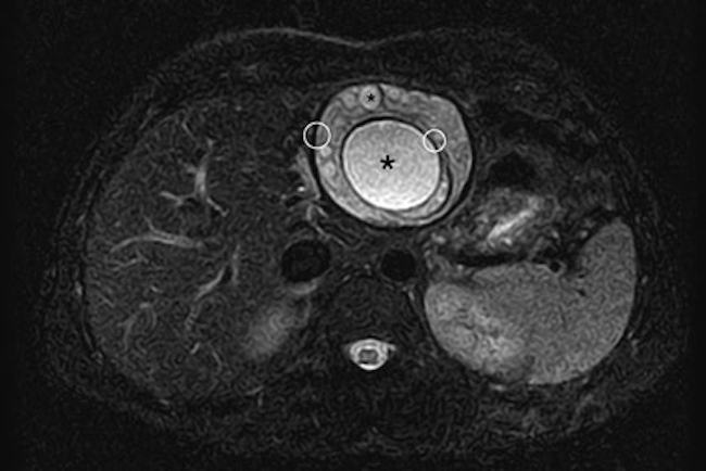Resonancia magnética de abdomen T2 Trigger, corte axial: lesión focal en el lóbulo hepático izquierdo con múltiples imágenes redondeadas hiperintensas (asteriscos), de aspecto quístico, con un sutil halo hipointenso correspondiendo al signo del anillo (circunferencias blancas). Gharbi tipo III-CE2.