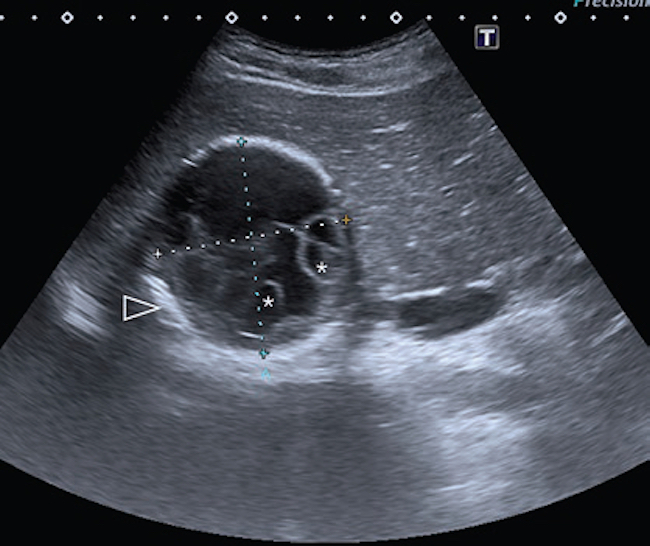 Paciente de 14 años con dolor abdominal generalizado asociado a vómitos. Ecografía de abdomen: se visualiza, en el lóbulo hepático derecho, una lesión focal anecoica con múltiples imágenes quísticas en su interior (asteriscos) y pared ecogénica engrosada (punta de flecha). Gharbi tipo III-CE2.