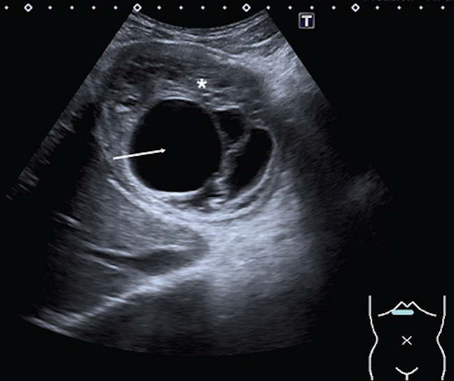 Paciente de 27 años con dolor en el epigastrio de varios días de evolución. Ecografía de abdomen: imagen focal en el lóbulo hepático izquierdo, de aspecto heterogénea, con áreas ecogénicas de aspecto sólido (asterisco) y quísticas en su interior (flecha blanca). Gharbi tipo IV-CE4.