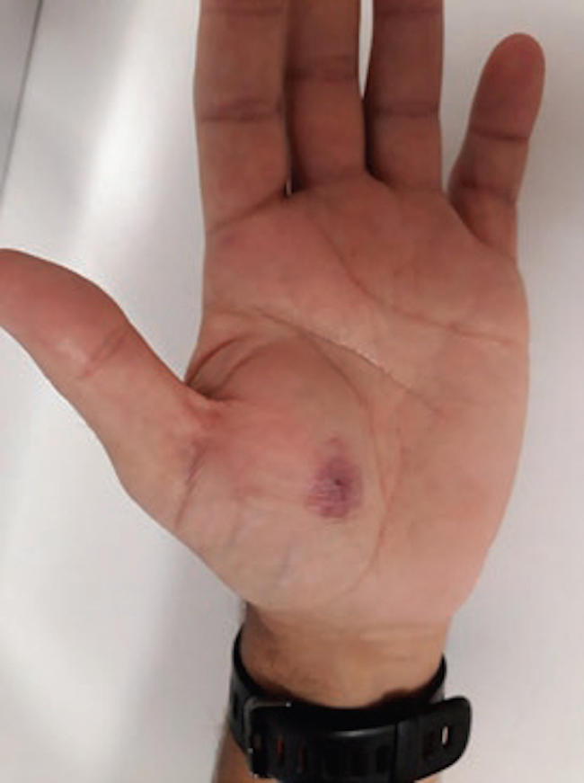 Imagen de la lesión de la mano izquierda. El aspecto muestra una lesión bien delimitada, enrojecida, en la eminencia tenar.