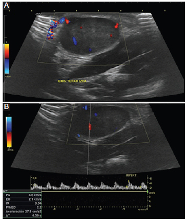 A y B: ecografía de partes blandas. Se visualiza una masa bien definida, ovoidea, en contacto con los músculos de la eminencia tenar de la mano izquierda, con abundante vascularización arterial mediante la señal Doppler.