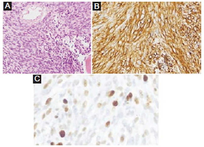Imágenes anatomopatológicas. A: proliferación de células fusiformes de alta densidad con patrón fasciculado sin observar necrosis, con mitosis aisladas (HE, magnificación original, 60×). B: en el estudio inmunohistoquímico, la tumoración es positiva para CD34 y negativa para proteína S100, siendo estos hallazgos típicos de este tumor (CD 34, magnificación original, 80×). C: el índice de proliferación valorado mediante el porcentaje de expresión de Ki67 es bajo, del 1-2%, mostrando un comportamiento benigno.