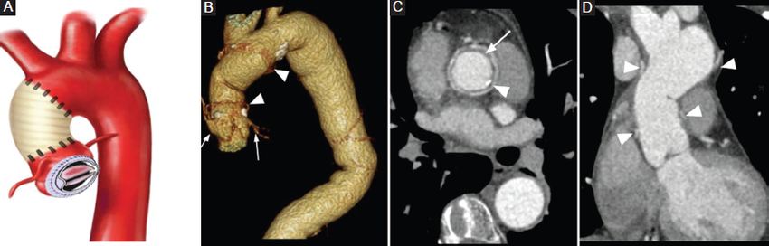 ATCMC que muestra los cambios anatómicos de la aorta ascendente tras la reparación con procedimiento de Wheat. A: diagrama ilustrativo del sitio de anastomosis entre la aorta, el injerto y la válvula protésica. B: 3D volume rendering mostrando el aspecto normal posoperatorio del procedimiento, los sitios de anastomosis (punta de flecha) y la indemnidad de las arterias coronarias nativas (flechas). C: reconstrucción axial oblicua MPR a la anastomosis proximal que muestra la prótesis aórtica hipodensa (flecha) en comparación con el contraste y los fieltros quirúrgicos circundantes (punta de flecha). D: reconstrucción coronal MPR que muestra los sitios de anastomosis proximal y distal (puntas de flecha).